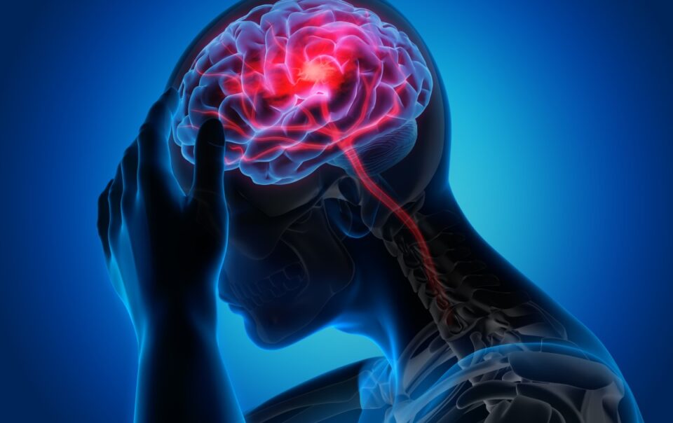 Does Hemorrhagic Stroke Qualify for Disability Benefits?
