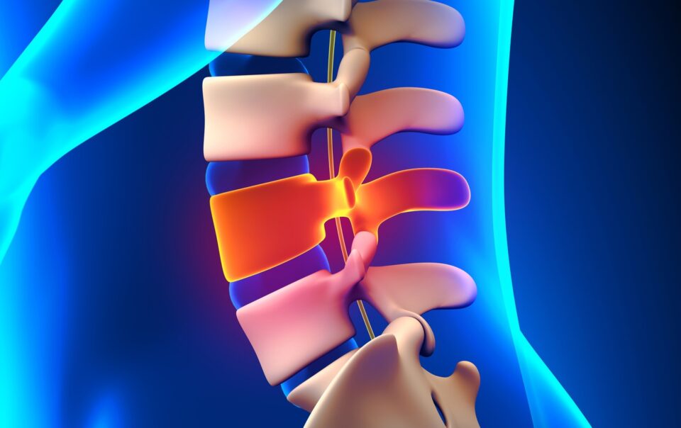 Can I Receive Disability Benefits for a Ruptured Disc?