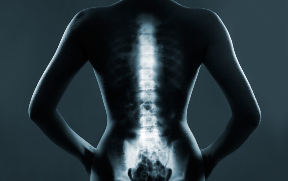Qualifying for Disability with Spinal Disorders