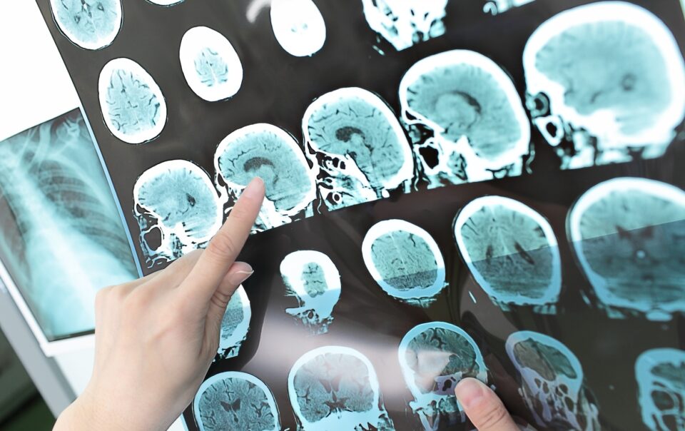 Stroke and Disability: Do You Qualify?