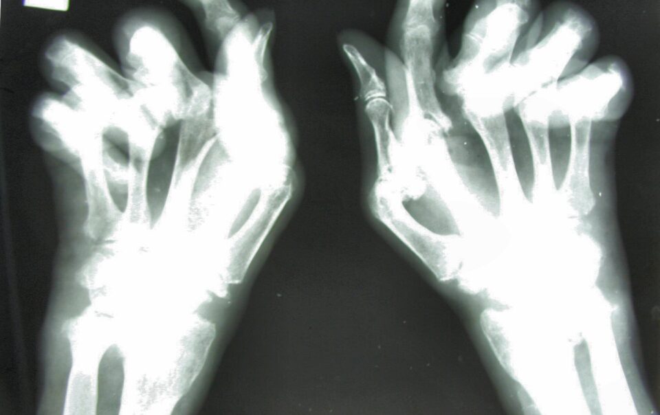 Arthritis and Disability: Do You Qualify?